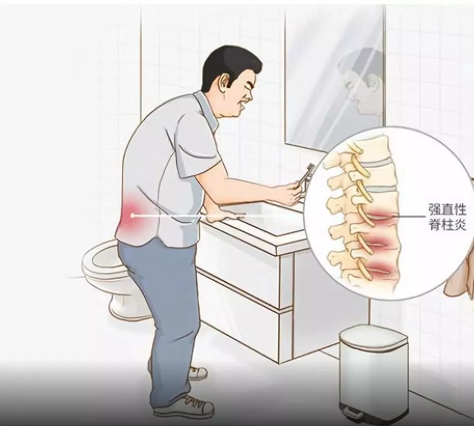 一文详细了解强直性脊柱炎,不可错过!