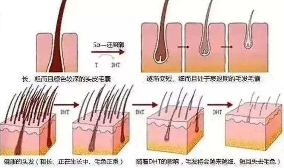 “发”问：如何判断自己是否雄性激素脱发。