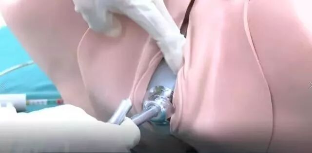 吸引器怎么握视频讲解：胎头吸引器手术的11个操作要点，助产士都要掌握_https://www.jmylbn.com_新闻资讯_第5张
