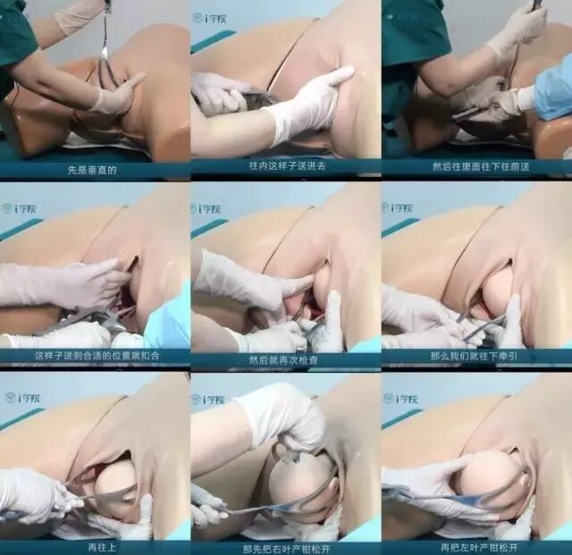 kielland产钳怎么翻译助产必备：『低位产钳术』图片+视频讲解详细步骤！_https://www.jmylbn.com_新闻资讯_第4张