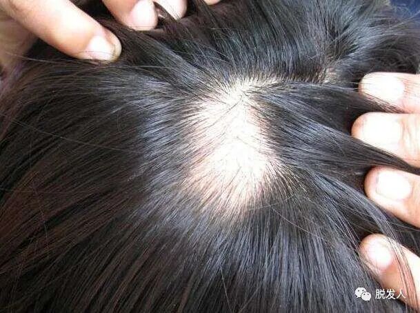 斑秃多久能长出头发？斑秃原来要这么治疗！