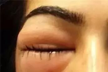 鼻塞时要不要擤鼻涕？有鼻炎的都后悔看晚了