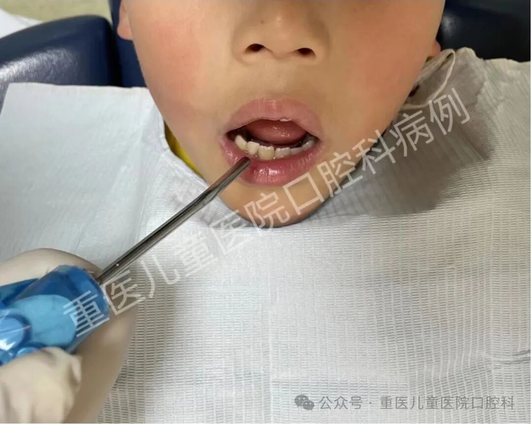 什么叫口腔器械【儿童口腔科普文章】 一起来认识口腔科检查常见器械吧！_https://www.jmylbn.com_新闻资讯_第21张