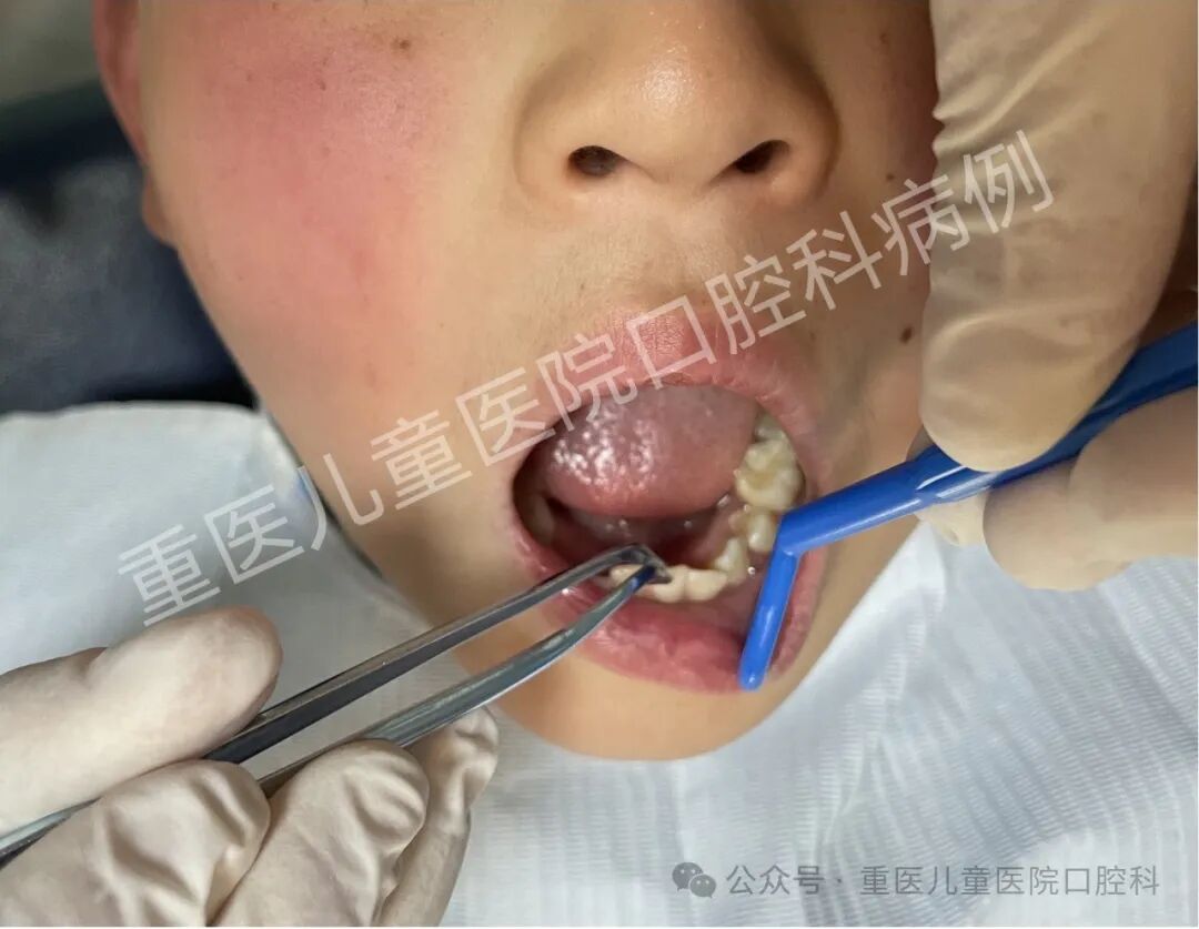 什么叫口腔器械【儿童口腔科普文章】 一起来认识口腔科检查常见器械吧！_https://www.jmylbn.com_新闻资讯_第15张