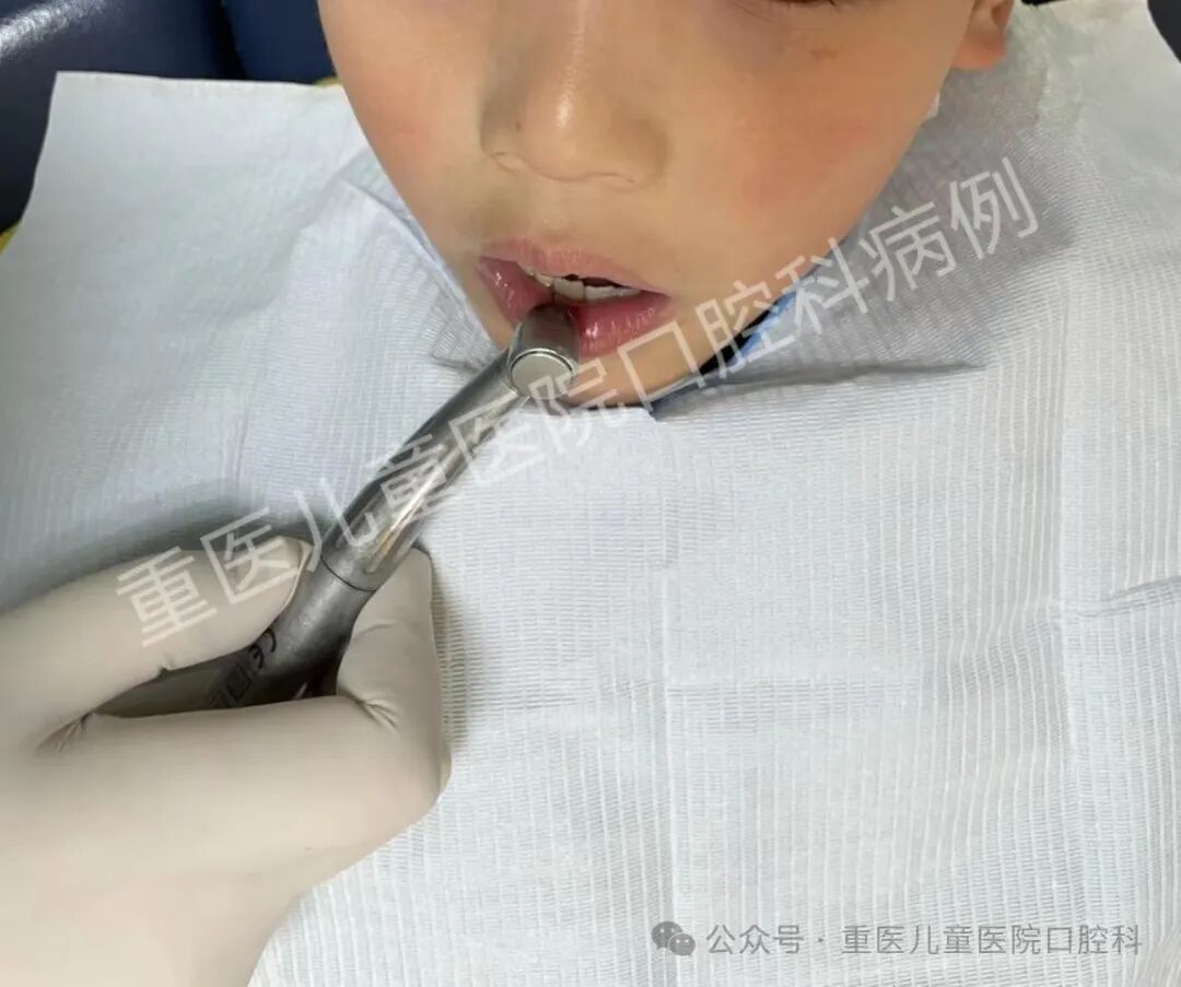 什么叫口腔器械【儿童口腔科普文章】 一起来认识口腔科检查常见器械吧！_https://www.jmylbn.com_新闻资讯_第24张