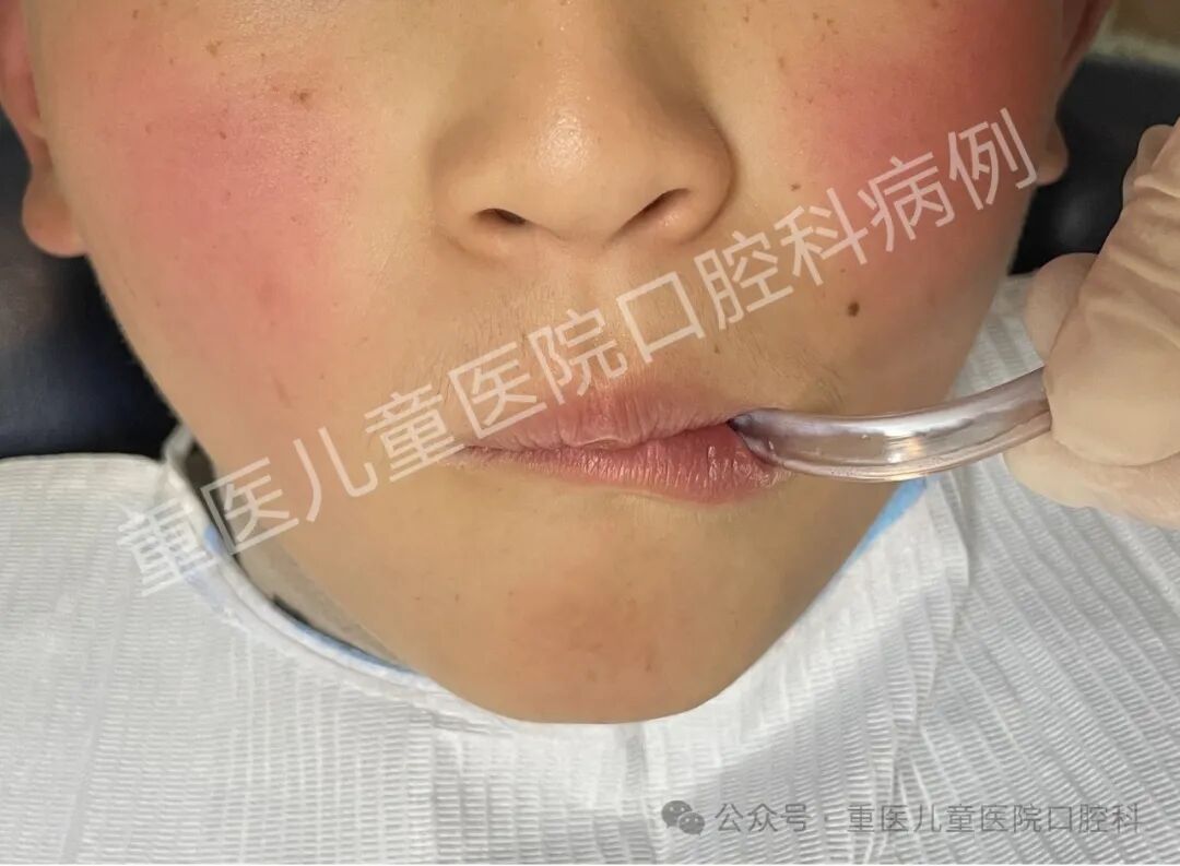 什么叫口腔器械【儿童口腔科普文章】 一起来认识口腔科检查常见器械吧！_https://www.jmylbn.com_新闻资讯_第18张