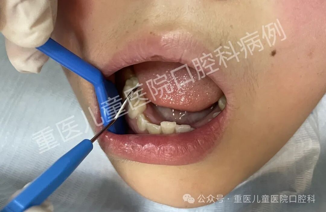 什么叫口腔器械【儿童口腔科普文章】 一起来认识口腔科检查常见器械吧！_https://www.jmylbn.com_新闻资讯_第12张