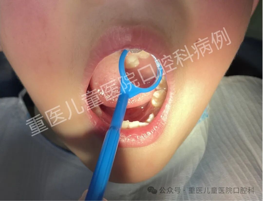 什么叫口腔器械【儿童口腔科普文章】 一起来认识口腔科检查常见器械吧！_https://www.jmylbn.com_新闻资讯_第9张