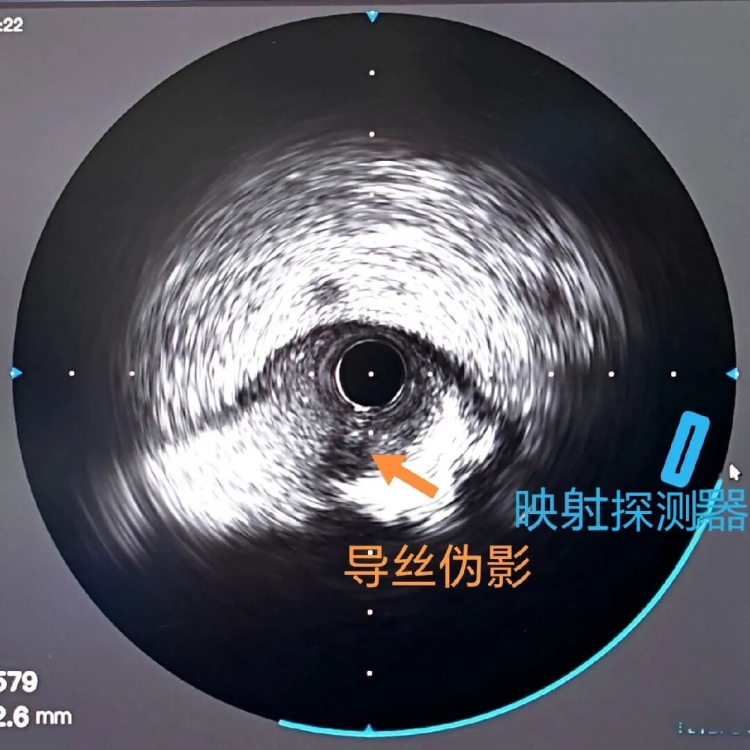 造影导丝是什么如何用“化身导丝”的理念去理解和实现 IVUS-造影配准？_https://www.jmylbn.com_新闻资讯_第23张