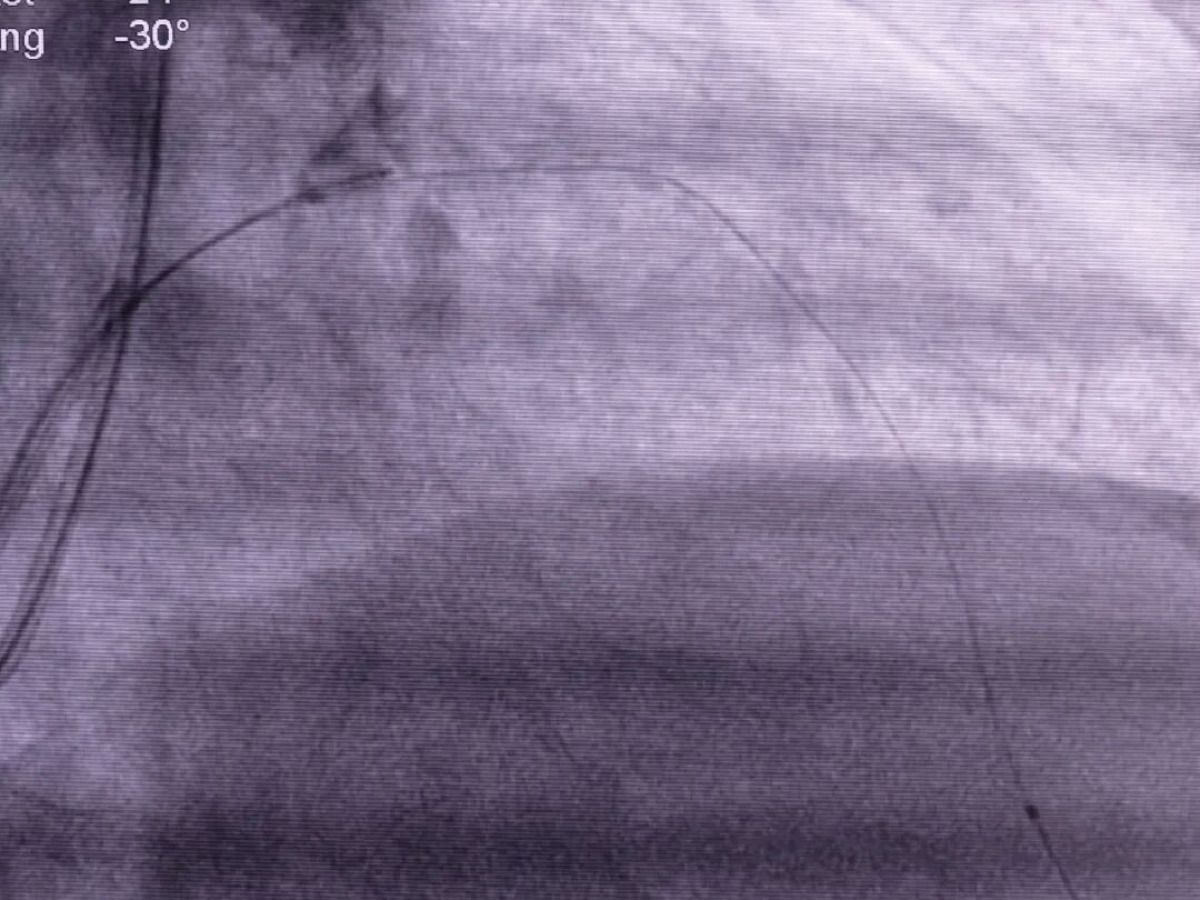 造影导丝是什么如何用“化身导丝”的理念去理解和实现 IVUS-造影配准？_https://www.jmylbn.com_新闻资讯_第22张