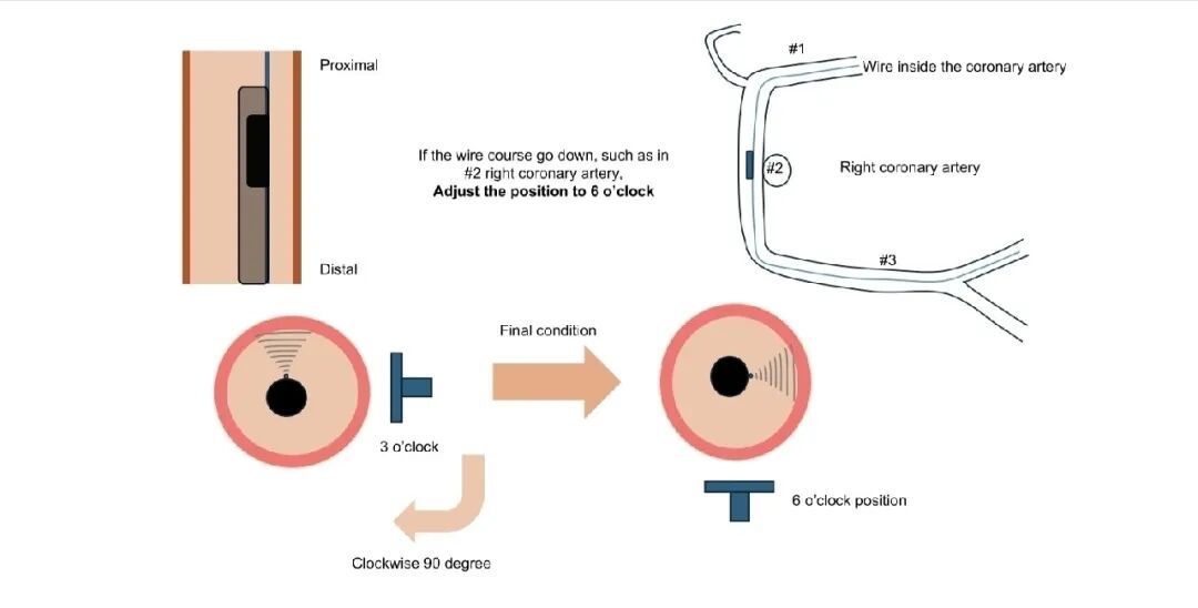造影导丝是什么如何用“化身导丝”的理念去理解和实现 IVUS-造影配准？_https://www.jmylbn.com_新闻资讯_第12张