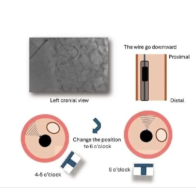 造影导丝是什么如何用“化身导丝”的理念去理解和实现 IVUS-造影配准？_https://www.jmylbn.com_新闻资讯_第19张
