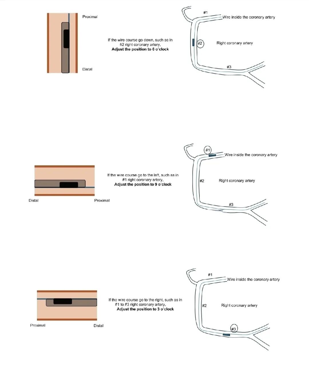 造影导丝是什么如何用“化身导丝”的理念去理解和实现 IVUS-造影配准？_https://www.jmylbn.com_新闻资讯_第8张