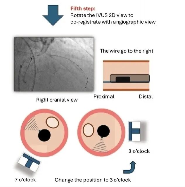造影导丝是什么如何用“化身导丝”的理念去理解和实现 IVUS-造影配准？_https://www.jmylbn.com_新闻资讯_第18张