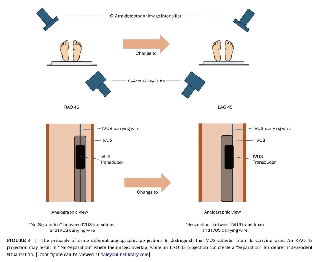 造影导丝是什么如何用“化身导丝”的理念去理解和实现 IVUS-造影配准？_https://www.jmylbn.com_新闻资讯_第6张