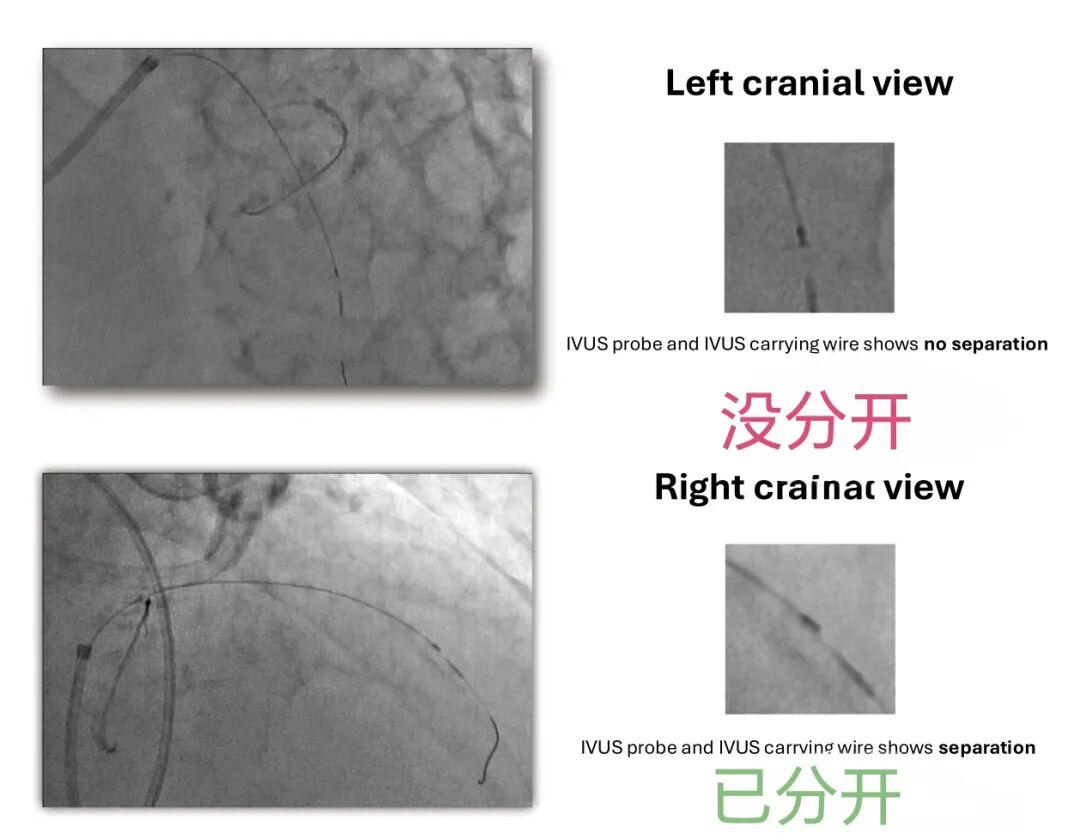 造影导丝是什么如何用“化身导丝”的理念去理解和实现 IVUS-造影配准？_https://www.jmylbn.com_新闻资讯_第7张