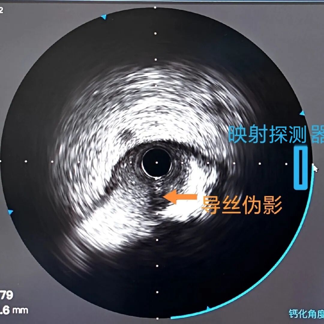 造影导丝是什么如何用“化身导丝”的理念去理解和实现 IVUS-造影配准？_https://www.jmylbn.com_新闻资讯_第24张