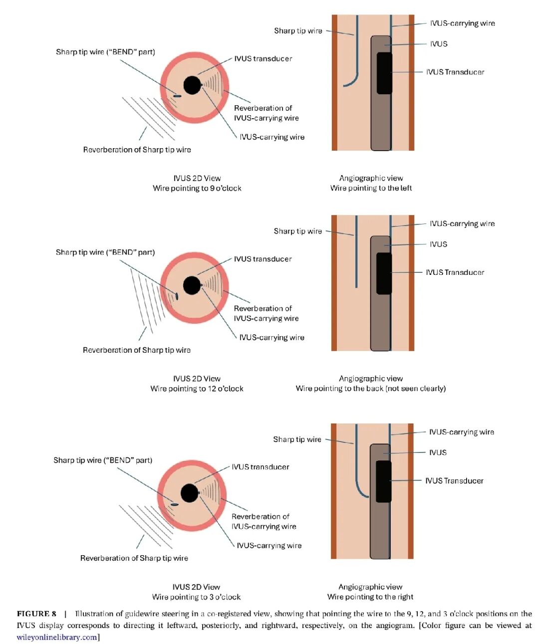 造影导丝是什么如何用“化身导丝”的理念去理解和实现 IVUS-造影配准？_https://www.jmylbn.com_新闻资讯_第15张