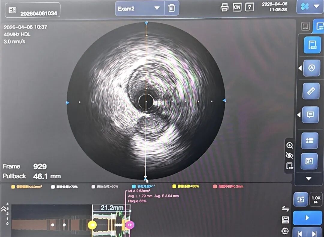 造影导丝是什么如何用“化身导丝”的理念去理解和实现 IVUS-造影配准？_https://www.jmylbn.com_新闻资讯_第5张