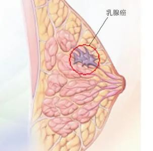 而对于非肿块型的乳腺癌,超声检查可能就不能发现,而在钼靶摄影片上