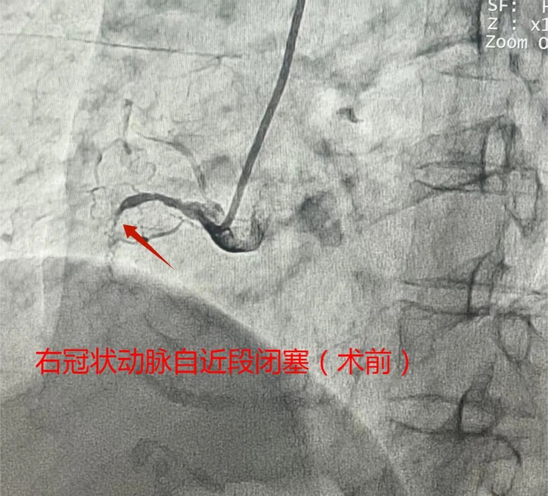 ace是什么手术【优势诊疗】冠脉介入最后的壁垒——慢性闭塞性病变（CTO）介入手术-上海聚慕医疗器械有限公司