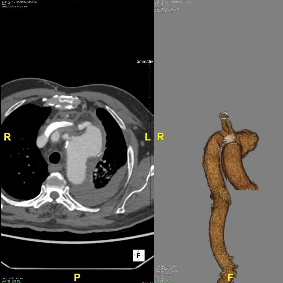 gore医疗怎么样「胸有乾坤」千钧一发 转危为安——Gore TBE治疗急诊破裂TAA一例_https://www.jmylbn.com_新闻资讯_第10张