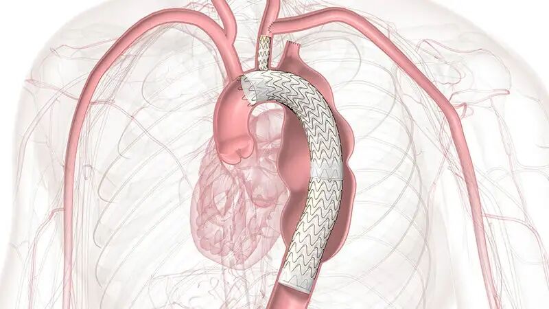 gore医疗怎么样「胸有乾坤」千钧一发 转危为安——Gore TBE治疗急诊破裂TAA一例_https://www.jmylbn.com_新闻资讯_第7张