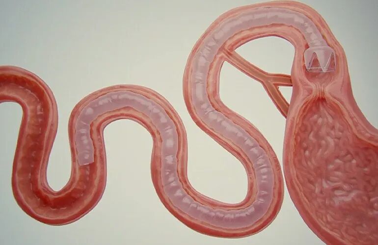 gore医疗怎么样ePTFE或将成为继镍钛合金之后，下一个重塑医疗器械领域的“现象级”材料_https://www.jmylbn.com_新闻资讯_第4张