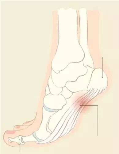 的疾病,如强直性脊柱炎等系统性疾病,小的骨折或疲劳骨折,肿瘤,神经痛