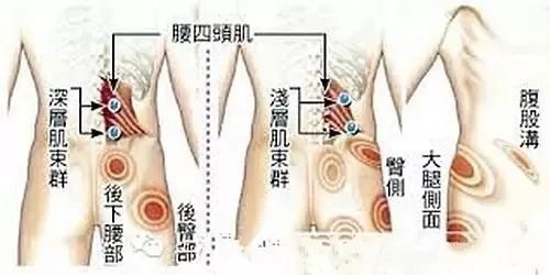 有一種傷不起的痛，叫肌筋膜炎 健康 第7張