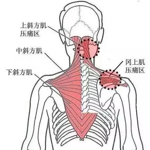 有一種傷不起的痛，叫肌筋膜炎 健康 第8張