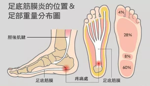 有一種傷不起的痛，叫肌筋膜炎 健康 第9張