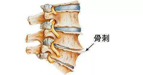 收藏！骨科大夫嘔心之作：關於膝關節炎的45問 健康 第6張