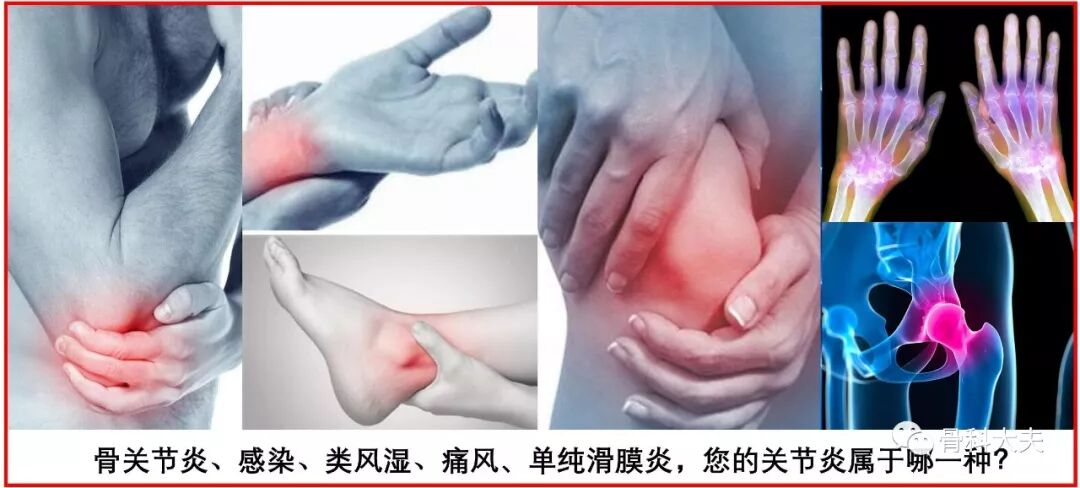 骨关节炎、感染、类风湿、痛风、单纯滑膜炎，您的关节炎属于哪一种？