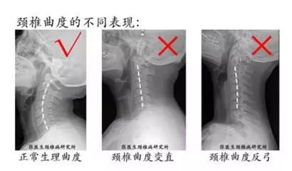 今天聊聊頸椎的故事 健康 第6張