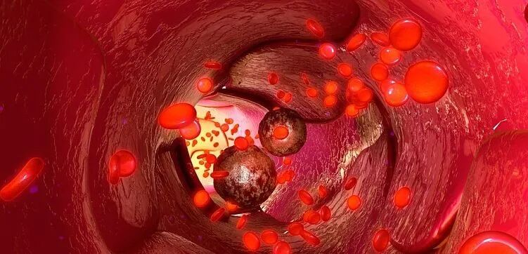 什么是臭氧大自血疗法三氧自血疗法对高血脂的作用！三氧大自血疗法治疗“高血脂”案例分享！_https://www.jmylbn.com_新闻资讯_第3张