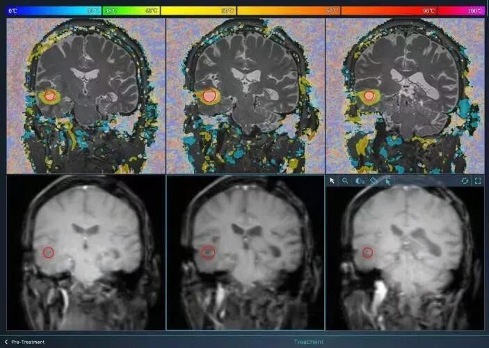 精密注塑成型：揭秘腫瘤激光消融器的研發過程的圖14