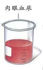 猪尾巴导管怎么拔出身体里面的“猪尾巴”导管_https://www.jmylbn.com_新闻资讯_第5张