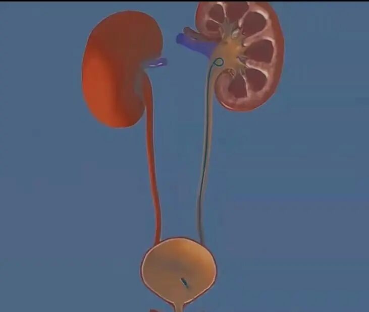 猪尾巴导管怎么拔出身体里面的“猪尾巴”导管_https://www.jmylbn.com_新闻资讯_第4张