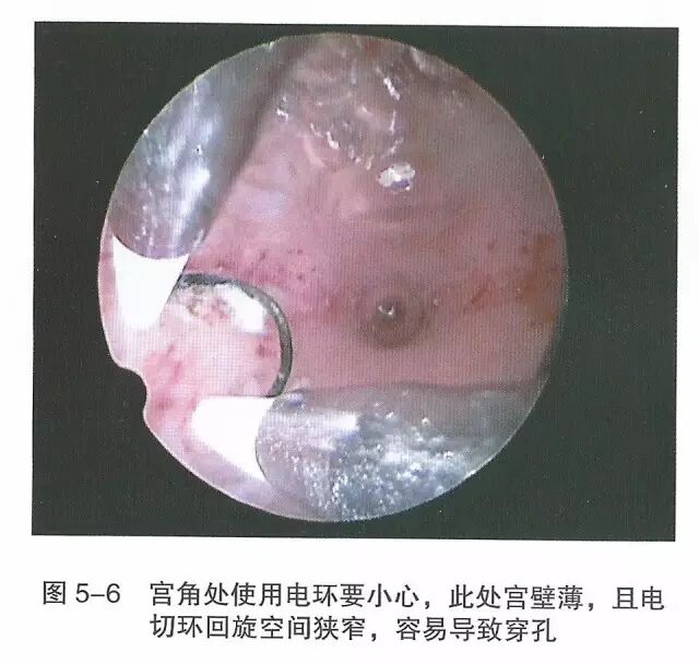 宫腔镜器械怎么组装【宫腔镜篇】器械简介_https://www.jmylbn.com_新闻资讯_第12张