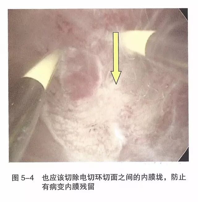 宫腔镜器械怎么组装【宫腔镜篇】器械简介_https://www.jmylbn.com_新闻资讯_第10张