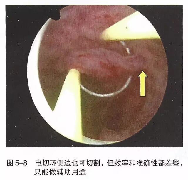 宫腔镜器械怎么组装【宫腔镜篇】器械简介_https://www.jmylbn.com_新闻资讯_第14张