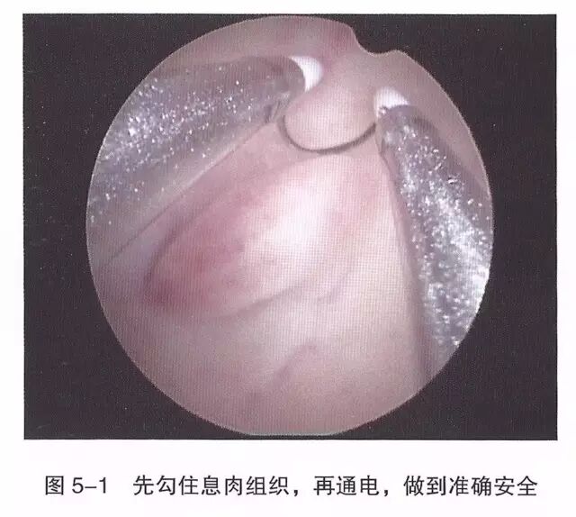 宫腔镜器械怎么组装【宫腔镜篇】器械简介_https://www.jmylbn.com_新闻资讯_第7张