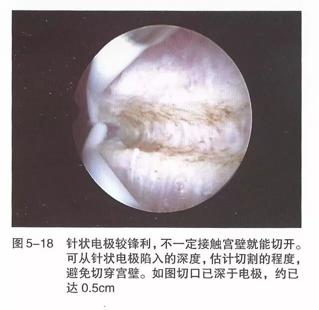 宫腔镜器械怎么组装【宫腔镜篇】器械简介_https://www.jmylbn.com_新闻资讯_第25张