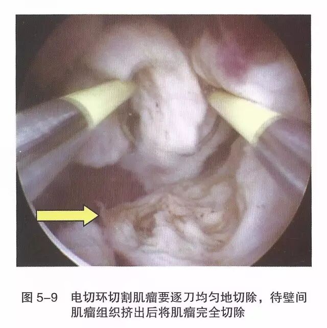 宫腔镜器械怎么组装【宫腔镜篇】器械简介_https://www.jmylbn.com_新闻资讯_第15张