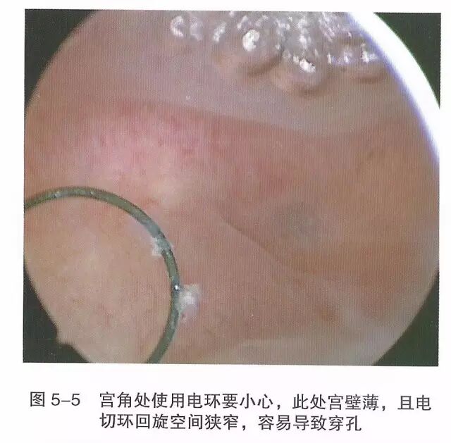 宫腔镜器械怎么组装【宫腔镜篇】器械简介_https://www.jmylbn.com_新闻资讯_第11张