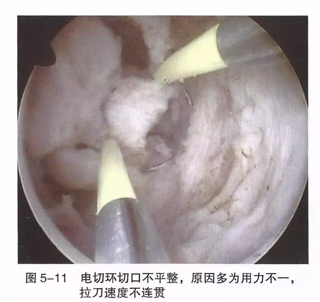 宫腔镜器械怎么组装【宫腔镜篇】器械简介_https://www.jmylbn.com_新闻资讯_第17张