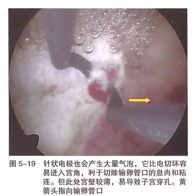 宫腔镜器械怎么组装【宫腔镜篇】器械简介_https://www.jmylbn.com_新闻资讯_第26张