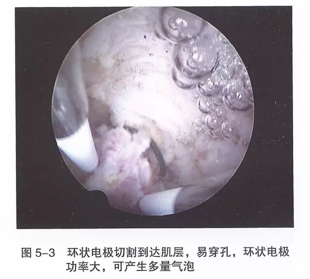 宫腔镜器械怎么组装【宫腔镜篇】器械简介_https://www.jmylbn.com_新闻资讯_第9张