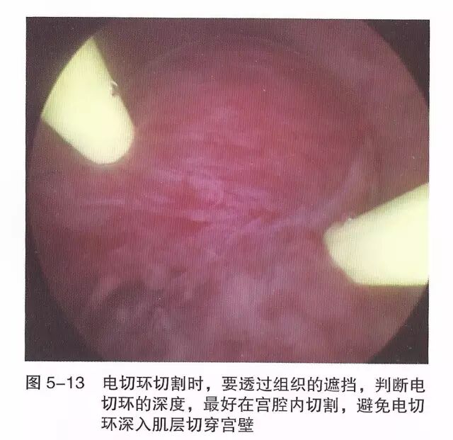 宫腔镜器械怎么组装【宫腔镜篇】器械简介_https://www.jmylbn.com_新闻资讯_第19张